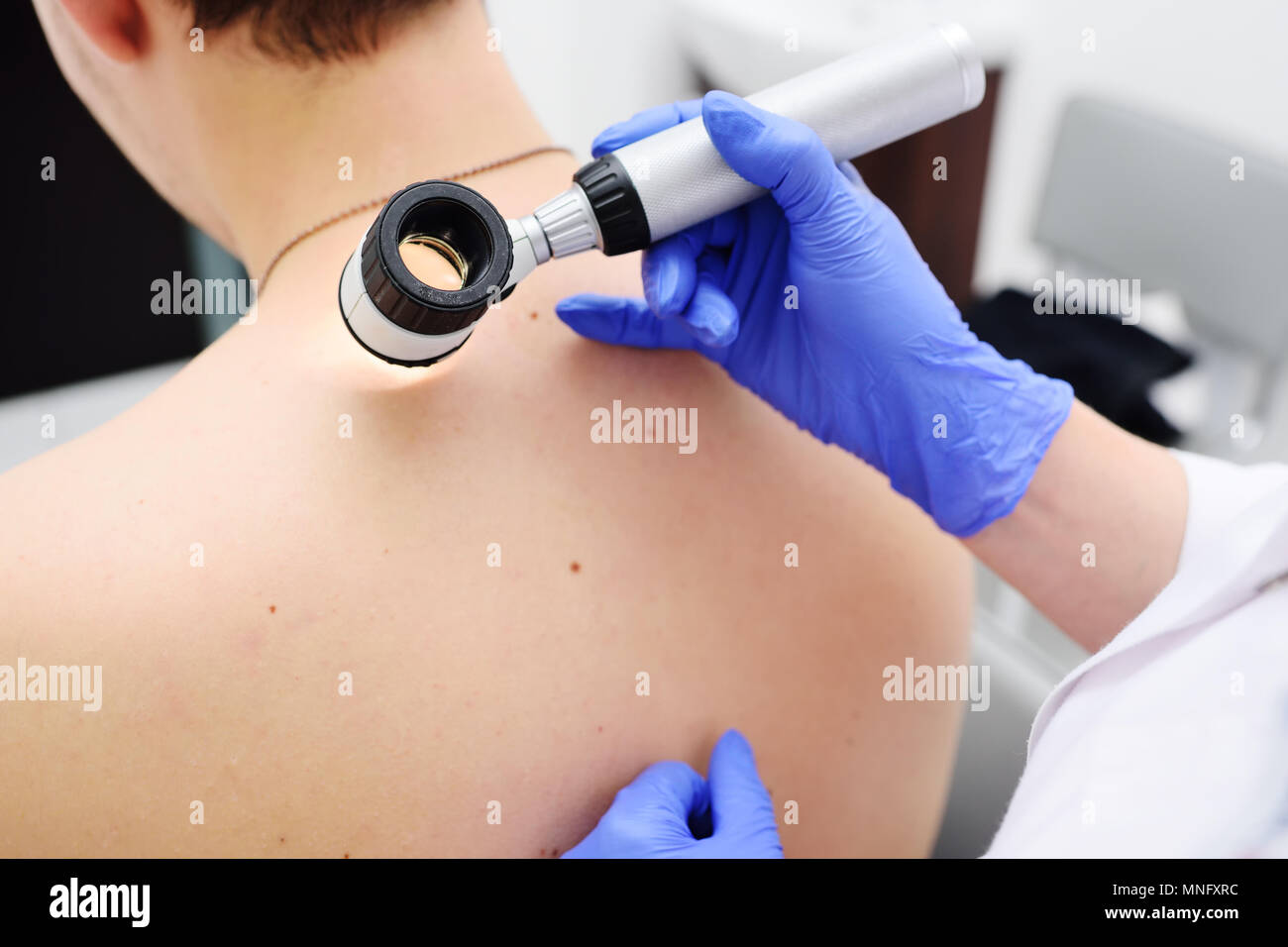 Il medico dermatologo esamina e birthmarks birthmarks del paziente con un dermatoscope Foto Stock
