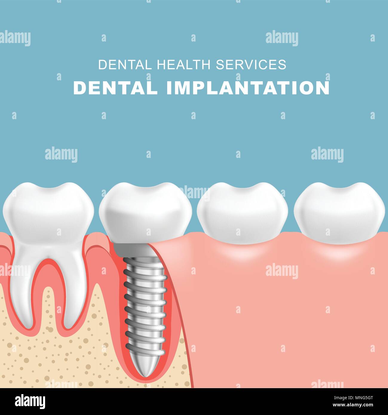 La sezione di gomma con implantat dentale - fila di denti Illustrazione Vettoriale
