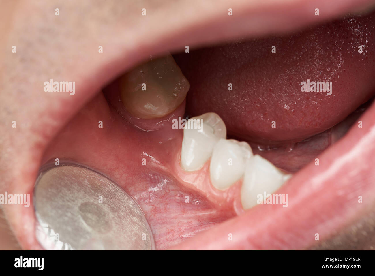 Dente divario nella bocca di uomo di close-up. Controllo medico uomo bocca Foto Stock
