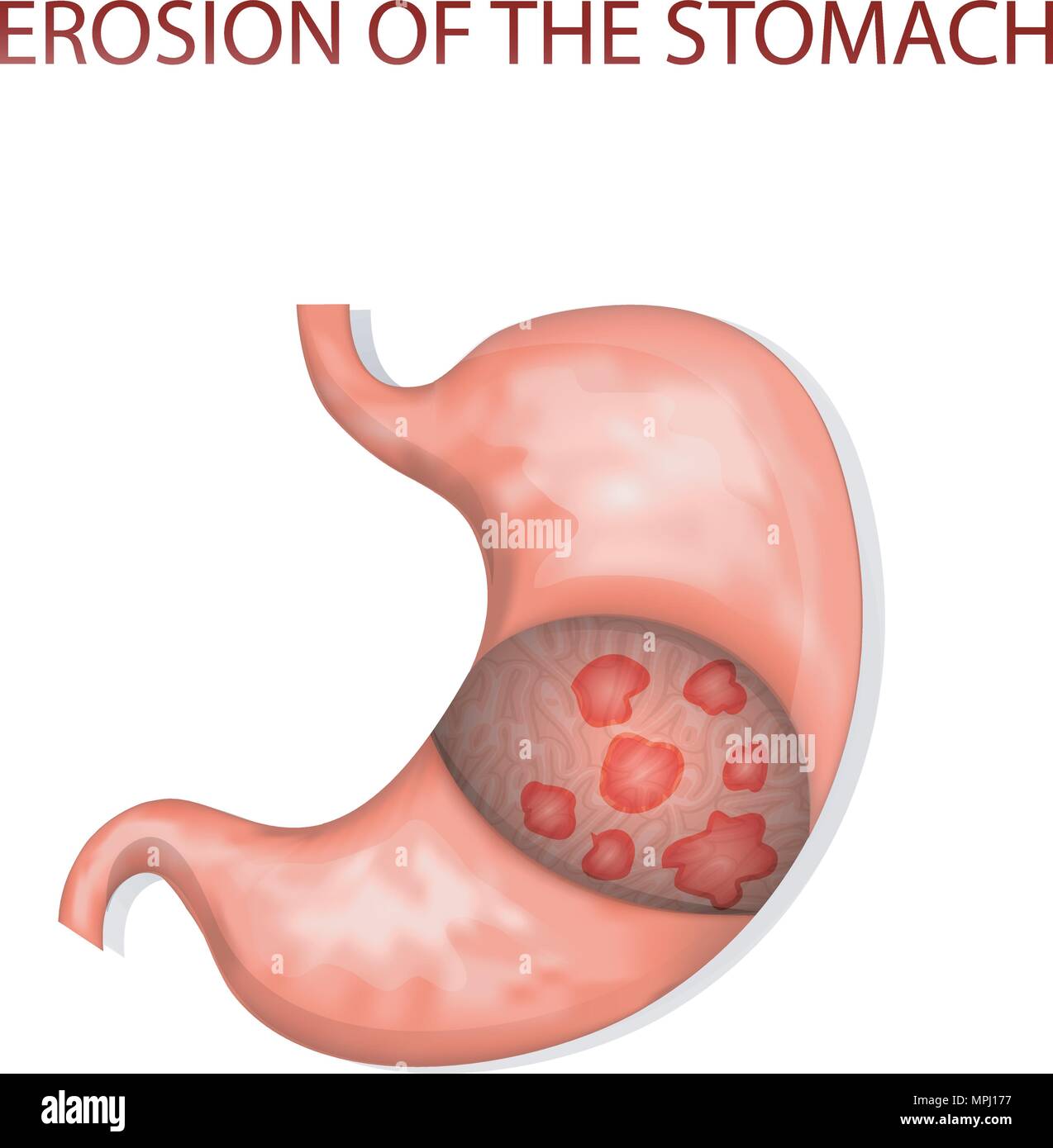Le illustrazioni della erosione dello stomaco Illustrazione Vettoriale
