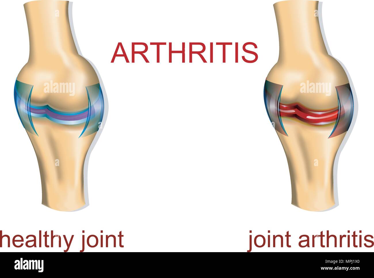 Un giunto sano e una articolazione affetta da artrite. Confronto Illustrazione Vettoriale