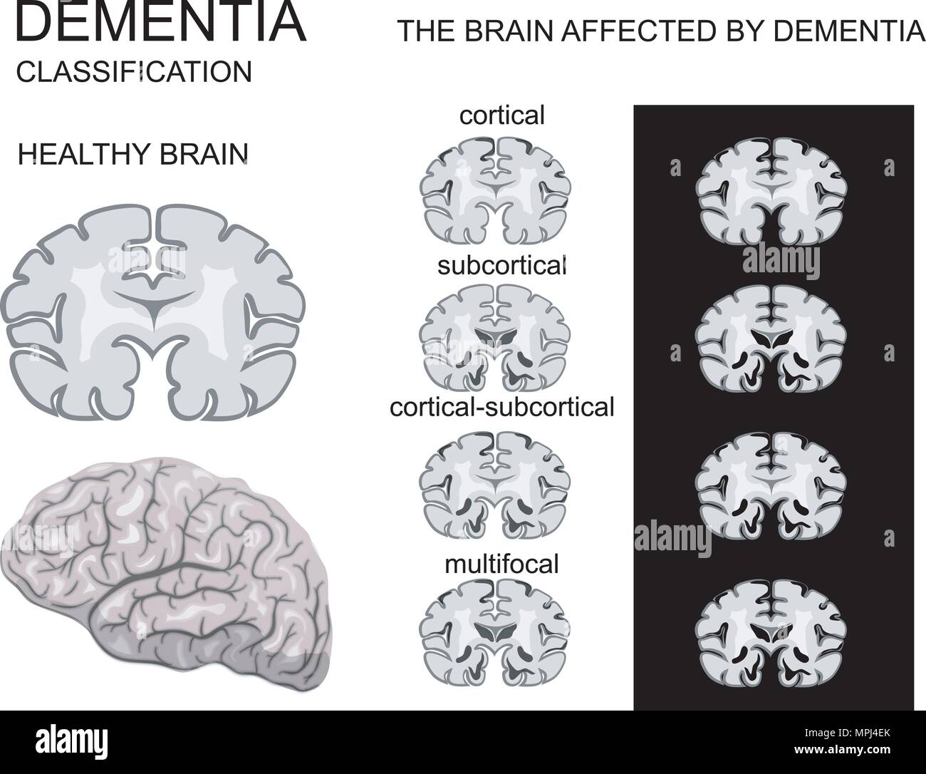 La demenza e la malattia di Alzheimer e la sua classificazione sistema nervoso Illustrazione Vettoriale