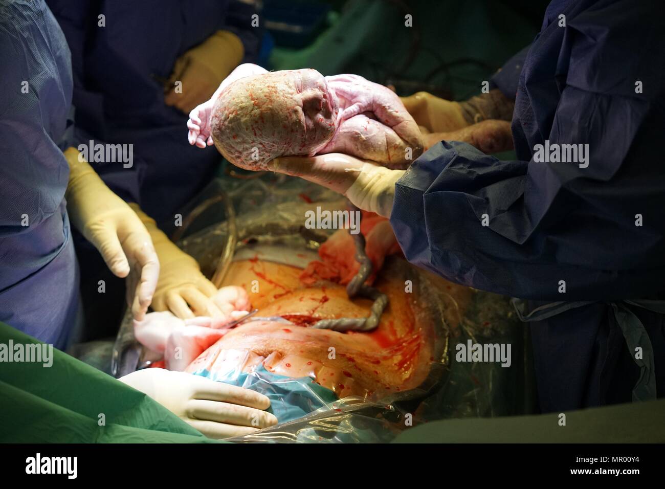Il bambino è nato da parto cesareo in ospedale coperta in vernix, cordone ombelicale ancora attaccato e madre della ferita chirurgica in background Foto Stock