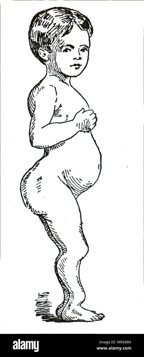 Illustrazione raffigurante la influenza di rachitismo di un ragazzo di età compresa tra i 3, mostrando il grasso per pasticceria e distorsione delle gambe e la posizione dell'addome. Il rachitismo è difettosa la mineralizzazione o calcificazione delle ossa prima della chiusura epiphyseal in mammiferi immaturi a causa di carenze o alterato metabolismo della vitamina D, fosforo o di calcio, portando potenzialmente a fratture e deformità. In data xx secolo Foto Stock