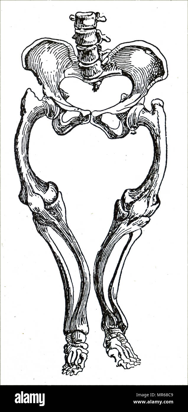 Incisione raffigurante una parte di un maschio di scheletro che mostra gli effetti di rachitismo sulla gamba di ossa. Il rachitismo è difettosa la mineralizzazione o calcificazione delle ossa prima della chiusura epiphyseal in mammiferi immaturi a causa di carenze o alterato metabolismo della vitamina D, fosforo o di calcio, portando potenzialmente a fratture e deformità. In data xx secolo Foto Stock