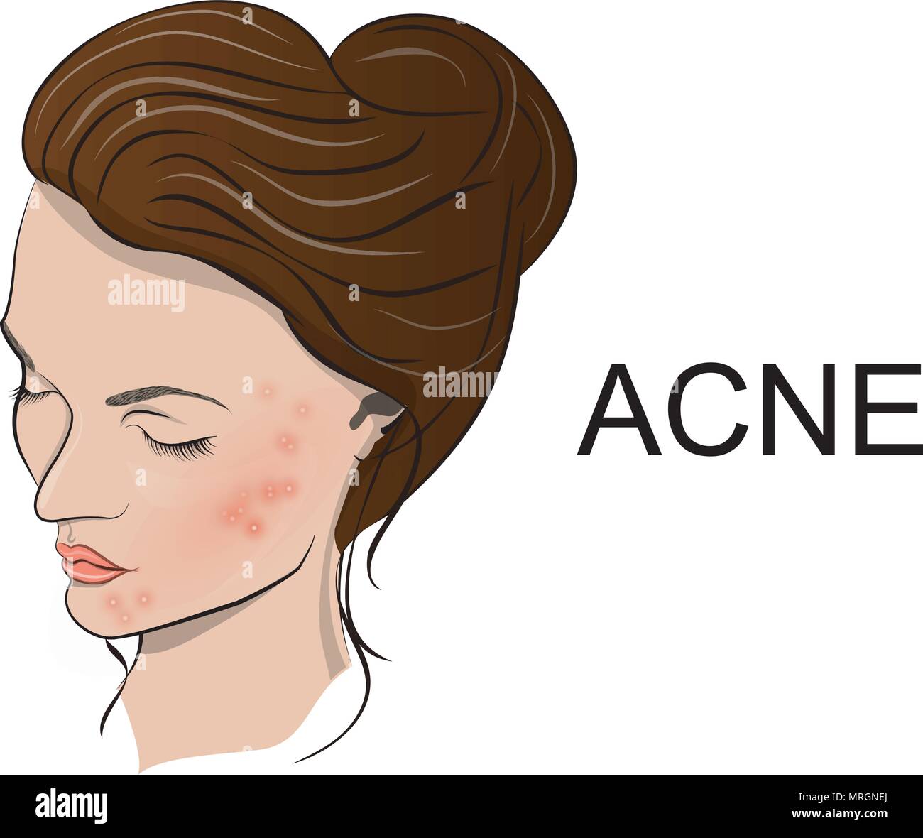 La giovane donna faccia con acne. vettore Illustrazione Vettoriale