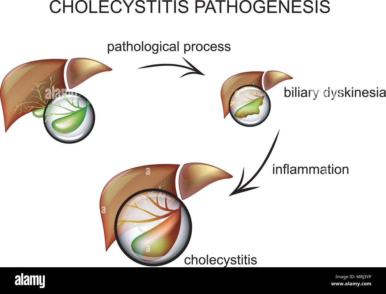 Illustrazione dell'infiammazione della cistifellea, la patogenesi della malattia Illustrazione Vettoriale
