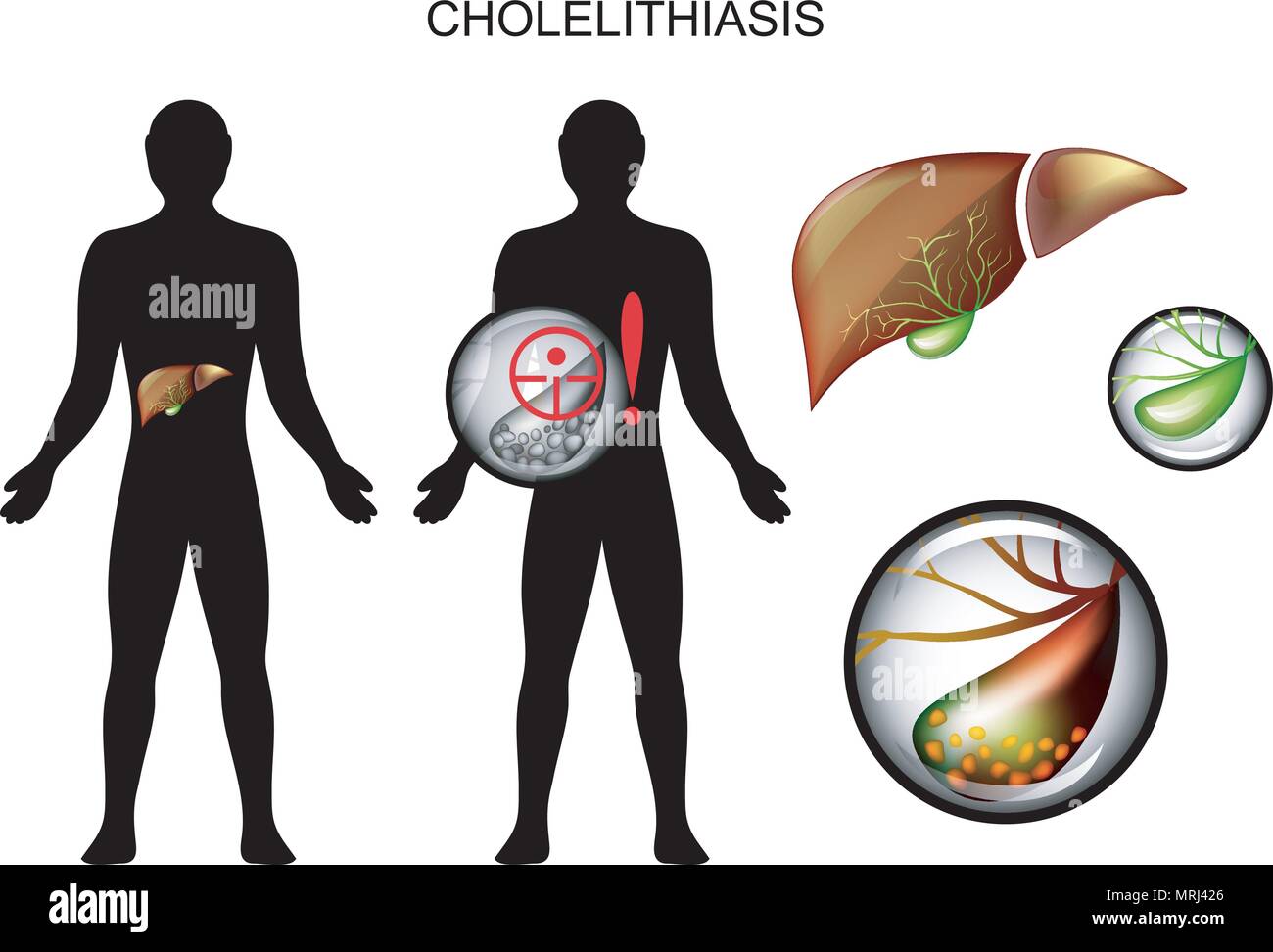 Illustrazione della malattia gallstone. dolore e sintomi Illustrazione Vettoriale