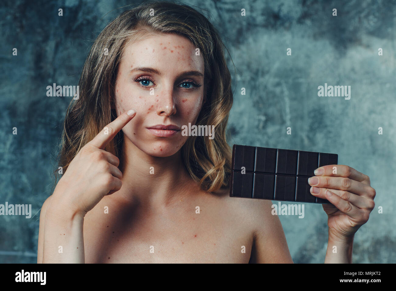 Giovane donna ha allergia sul cioccolato. Il suo viso hanno un sacco di acne e lei è infelice. Foto Stock