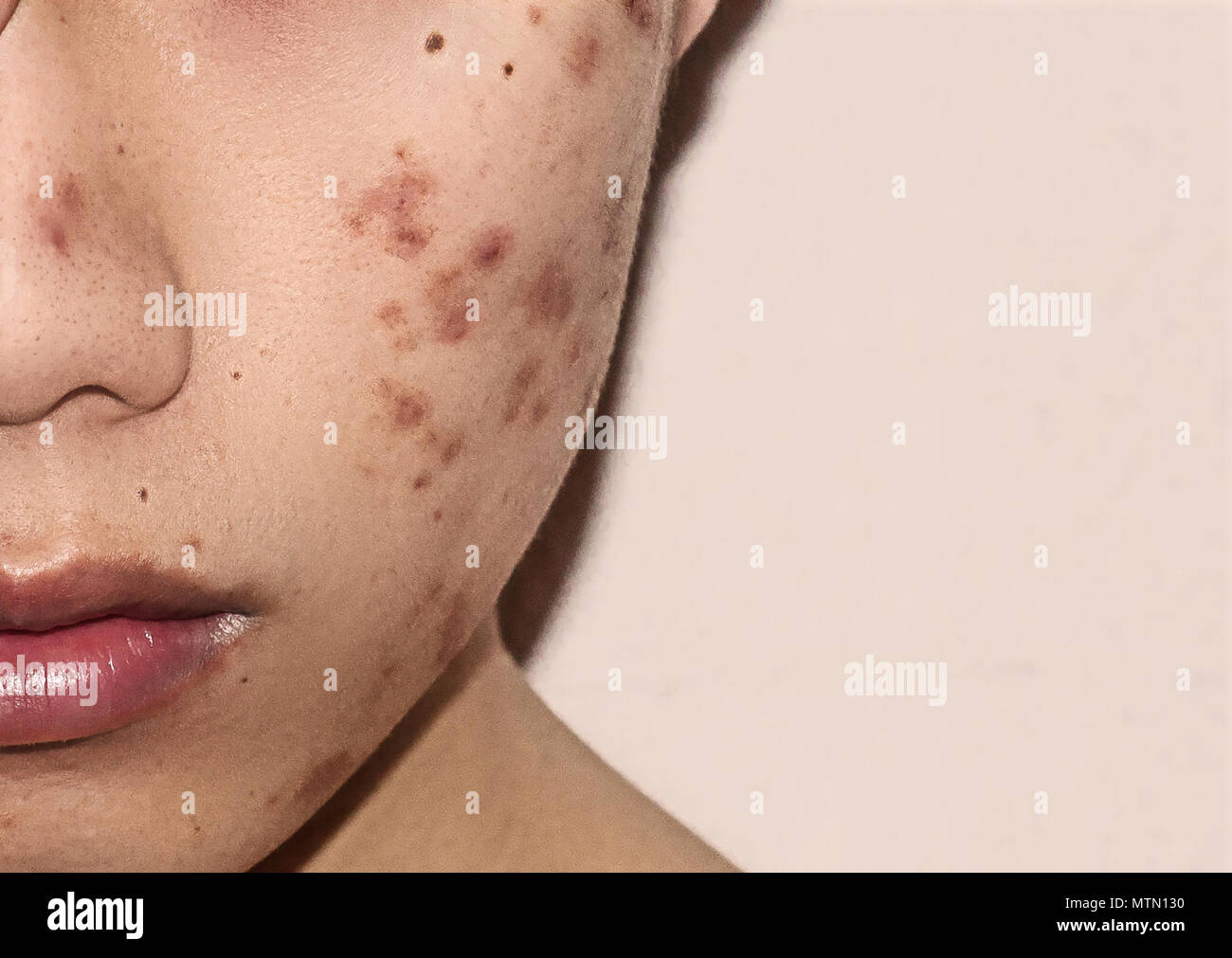 Close-up di acne sulla pelle, acne sul viso causate dagli ormoni,  cicatrici, rughe e acne infiammazione sulla pelle del viso Foto stock -  Alamy