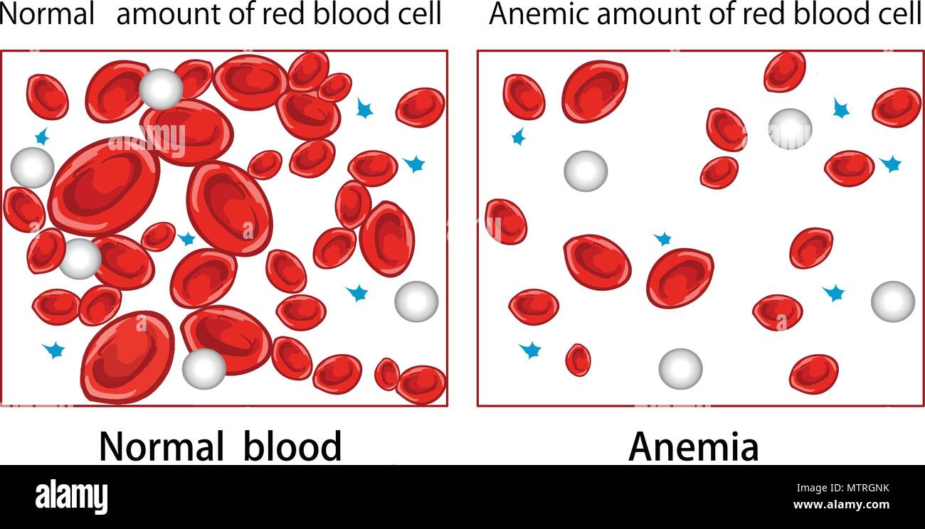 Illustrazione vettoriale di un diagramma di anemia Illustrazione Vettoriale