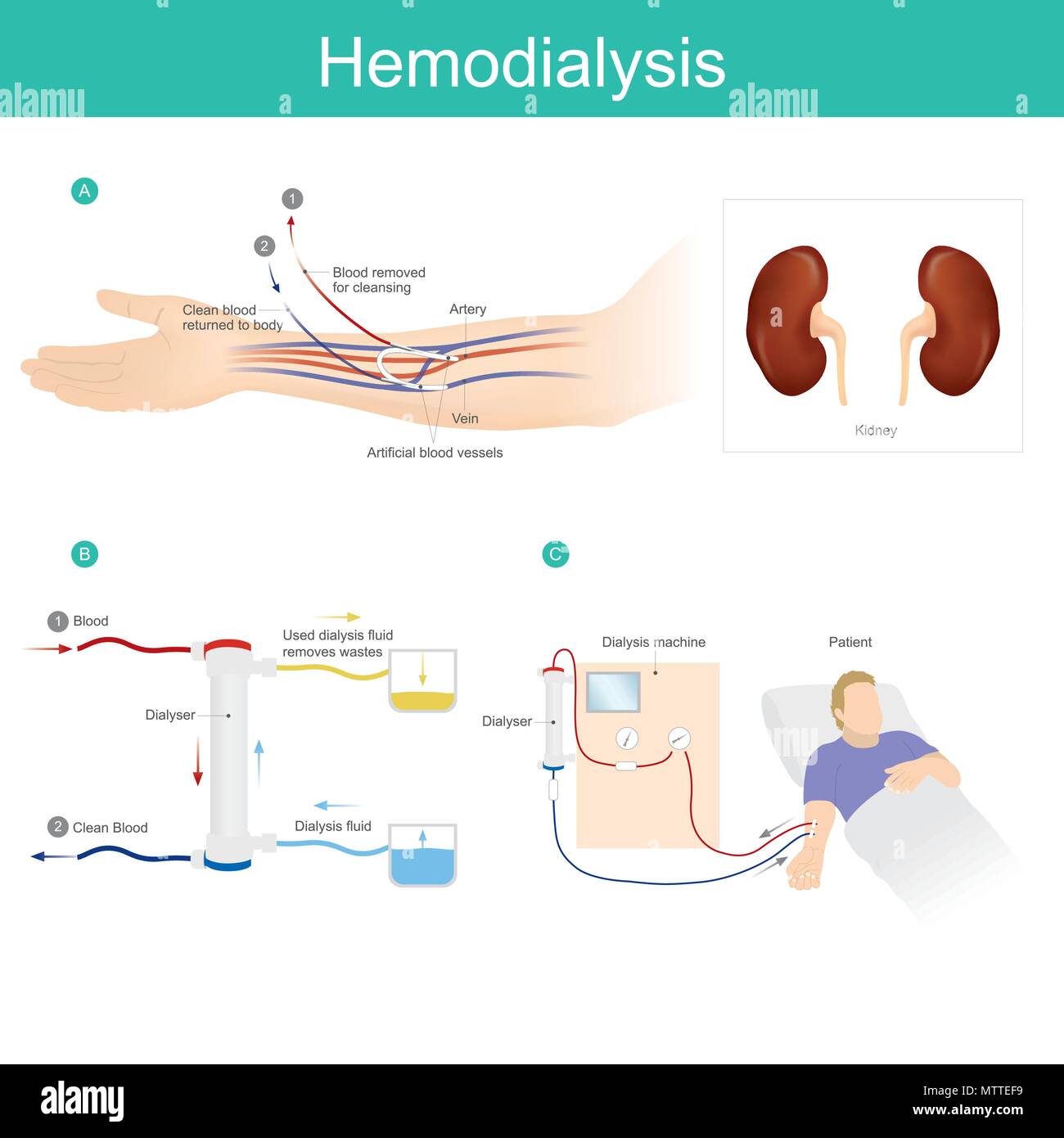 Il trattamento di pazienti con malattie renali croniche. Macchina per emodialisi utilizzati per filtrare ed eliminare i rifiuti che si è accumulato nel sangue. Essa aiuta a Illustrazione Vettoriale