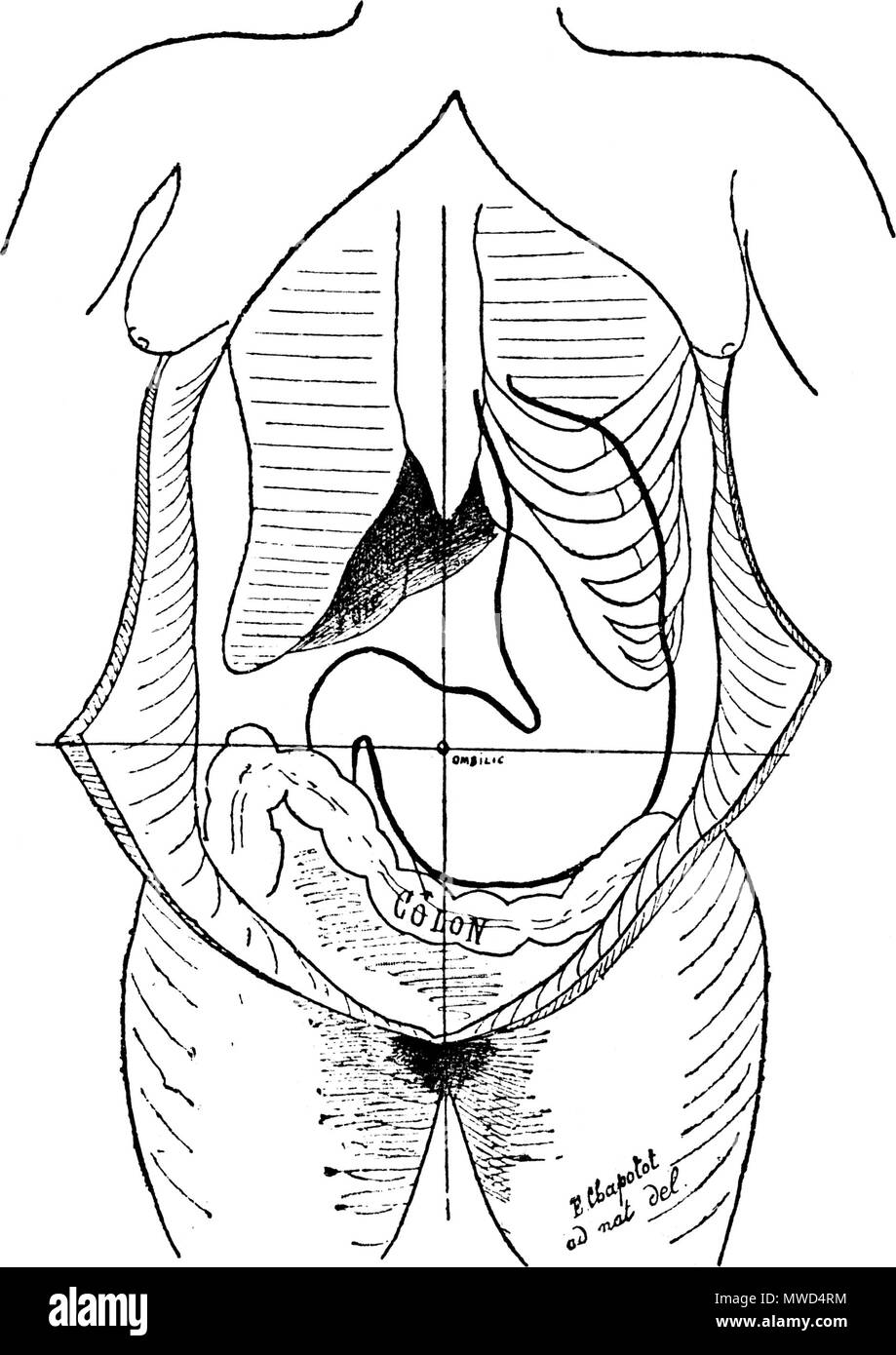 . Français : la figura 16 (d'après natura). Le côté droit du torace a été laissé schématisé pour montrer la déformation du torace. Inglese: Figura 16 (secondo natura). Sul lato destro del torace sinistro è stato schematizzato per mostrare la deformazione del torace. 1892. Le dr Eugène Chapotot 196 pagina EstomacCorset066 Foto Stock