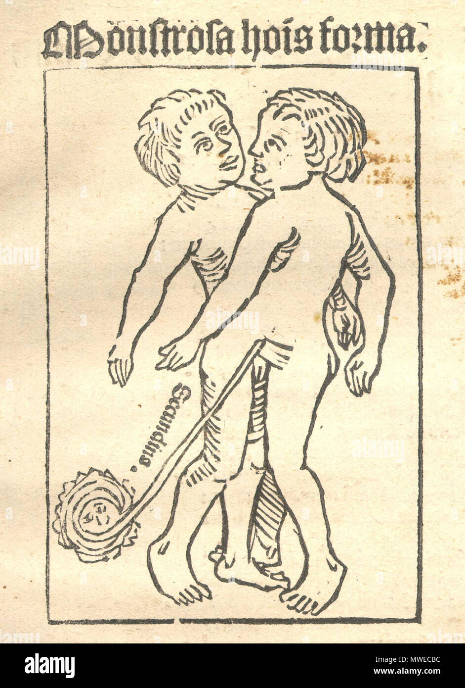 304 GiacobbeLocher-Conjoinedgemelli Foto Stock