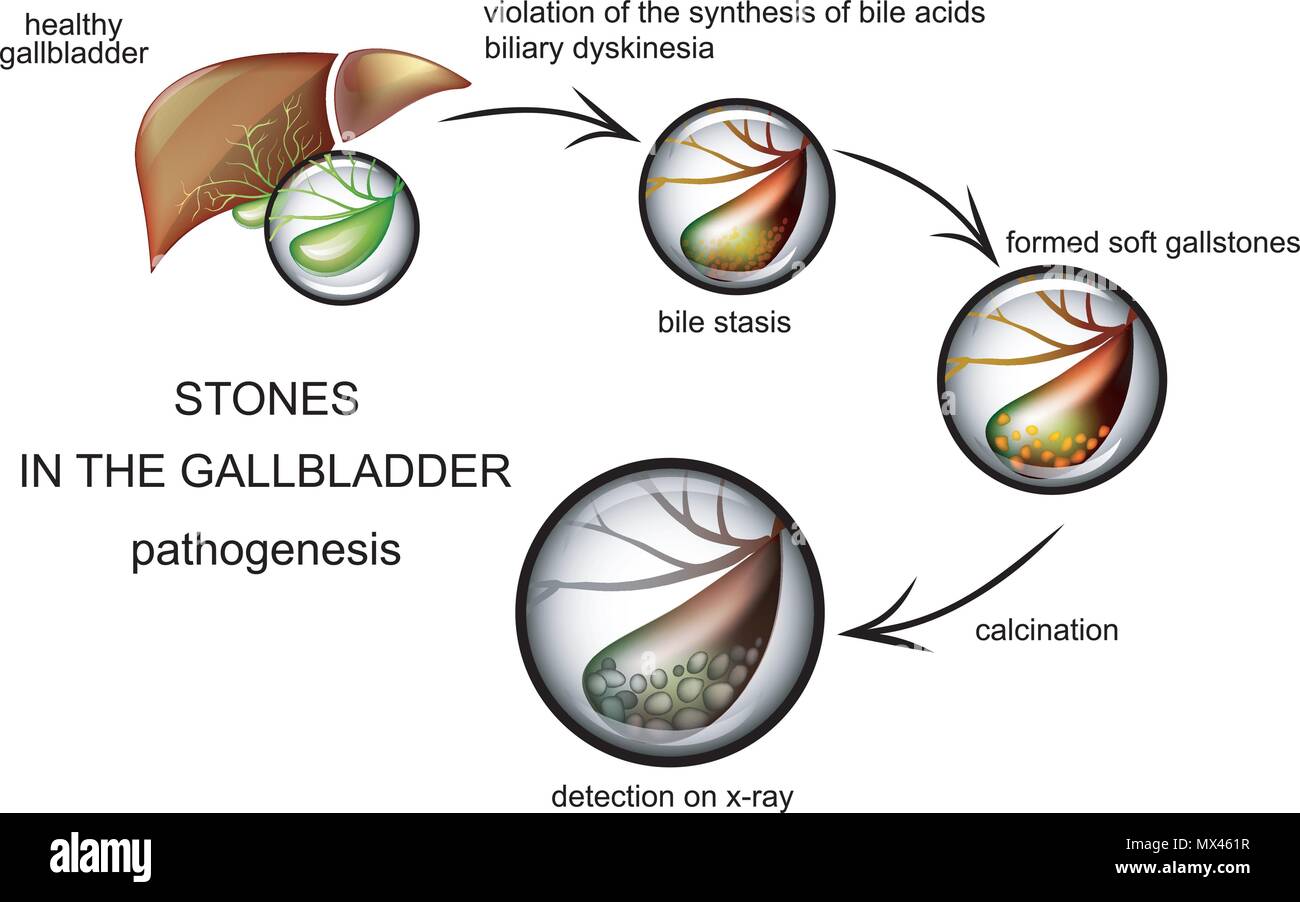 Illustrazione della malattia gallstone. la patogenesi della malattia Illustrazione Vettoriale