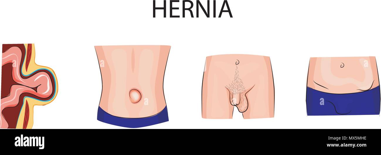 Illustrazione del cordone ombelicale e ernia inguinale, schiacciati Illustrazione Vettoriale