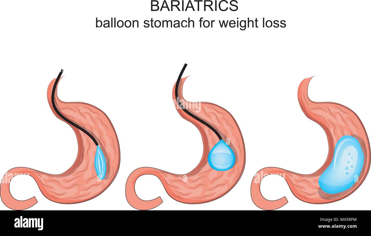 Illustrazione del palloncino nello stomaco per la perdita di peso Immagine  e Vettoriale - Alamy
