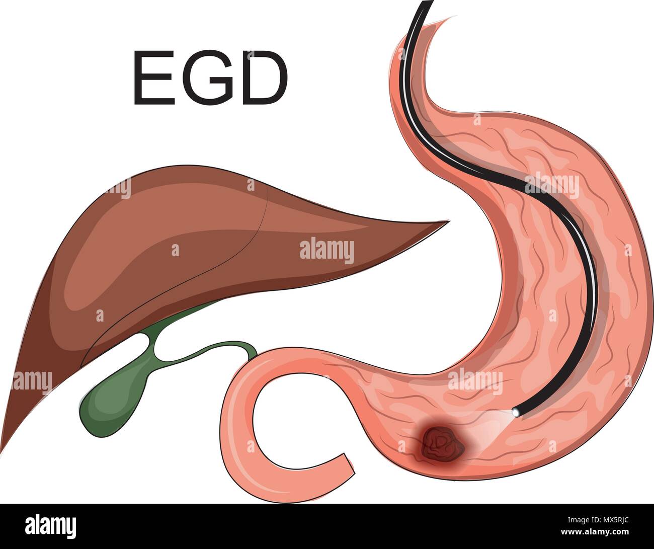 Illustrazione di EGD, ulcera peptica. esame dello stomaco Illustrazione Vettoriale