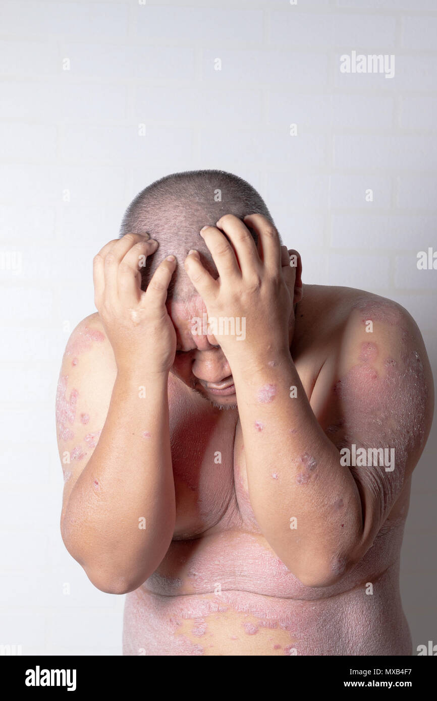 Gli uomini sono utilizzando entrambe le mani per tenere la sua testa, psoriasi sforzare. Le malattie causate da anomalie della linfa. La psoriasi è una malattia della pelle. Foto Stock