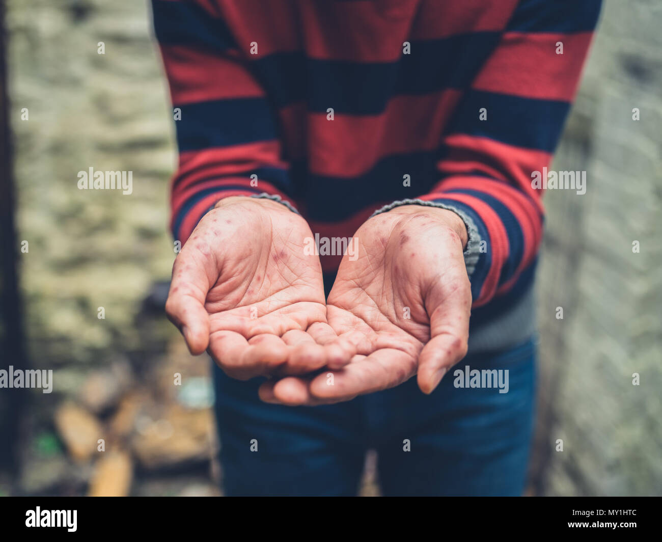 Chiudere fino alle mani di un giovane con un rash sulle sue mani mendicare al di fuori Foto Stock