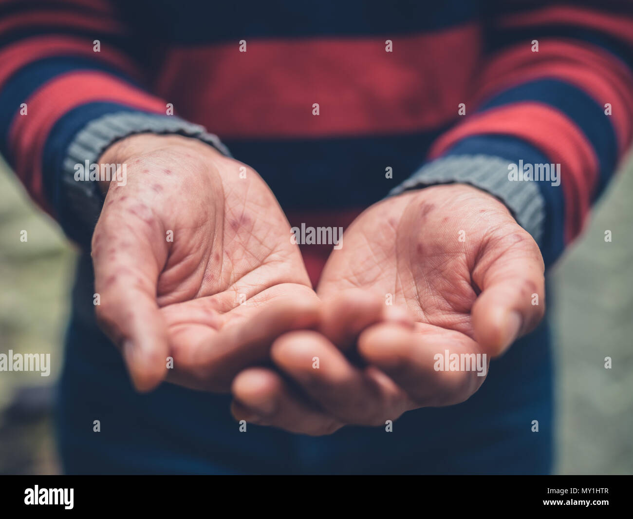 Chiudere fino alle mani di un giovane con un rash sulle sue mani mendicare al di fuori Foto Stock