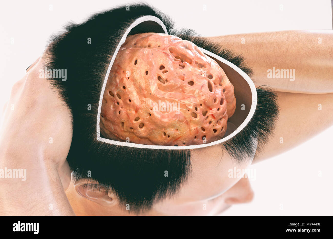 La demenza e la malattia di Alzheimer - immagine 2 di 2 - 3D Rendering Foto Stock