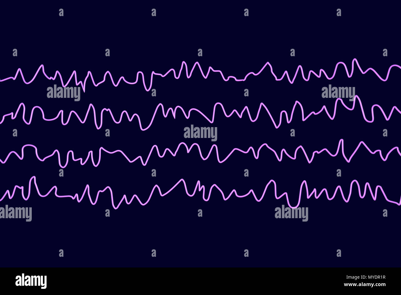 Le onde cerebrali in stato sveglio durante il riposo, illustrazione del computer. Un'elettroencefalogramma (EEG) misura l'attività elettrica del cervello utilizzando elettrodi collegati al cuoio capelluto. Vari disturbi possono essere diagnosticati analizzando i risultati EEG. Foto Stock