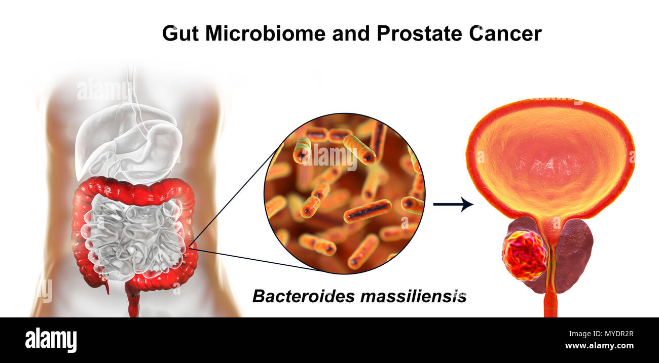 Gut microbiome e cancro della prostata. Illustrazione concettuale che illustra l'associazione dei Bacteroides massiliensis batteri nell'intestino crasso allo sviluppo del cancro prostatico. Foto Stock
