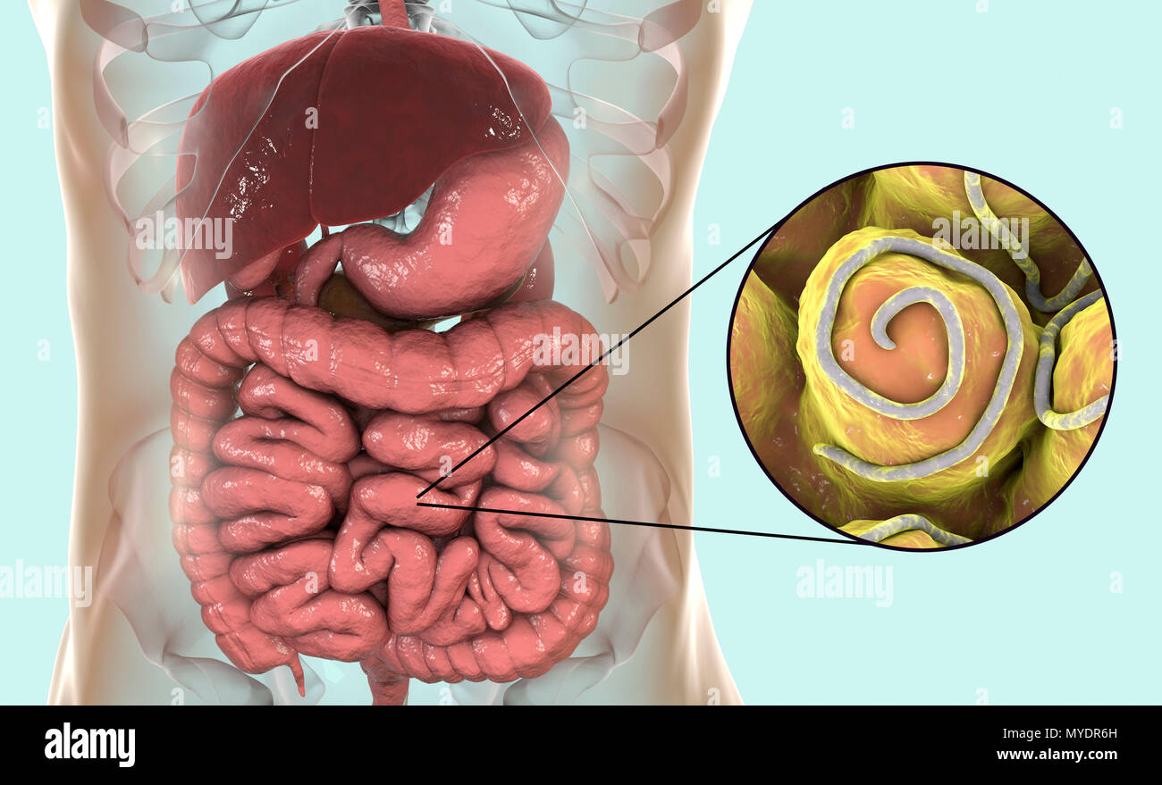 Threadworm infezione. Computer illustrazione che mostra più trichine (Enterobius sp.) nell'intestino umano. Trichine sono nematodi che parasitize l'intestino crasso e intestino cieco di molti animali. Negli esseri umani sono cause comuni di infezione enterobiasis. Nematodi sono non segmentata di worm che può essere parassita o libero-vivente a seconda della specie. Foto Stock