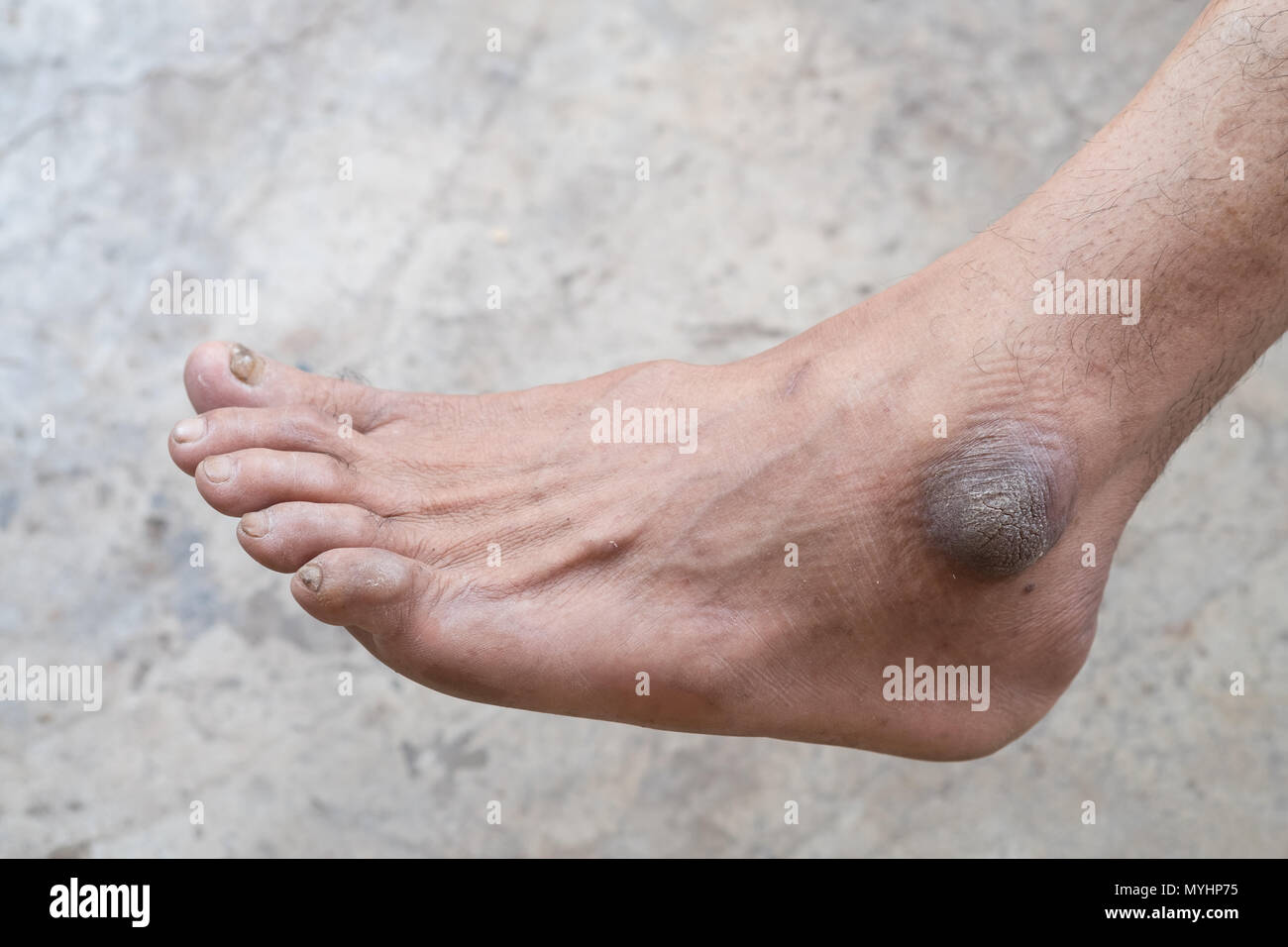 Vista dettagliata del piede con una infezione dei piedi causate da funghi. Foto Stock