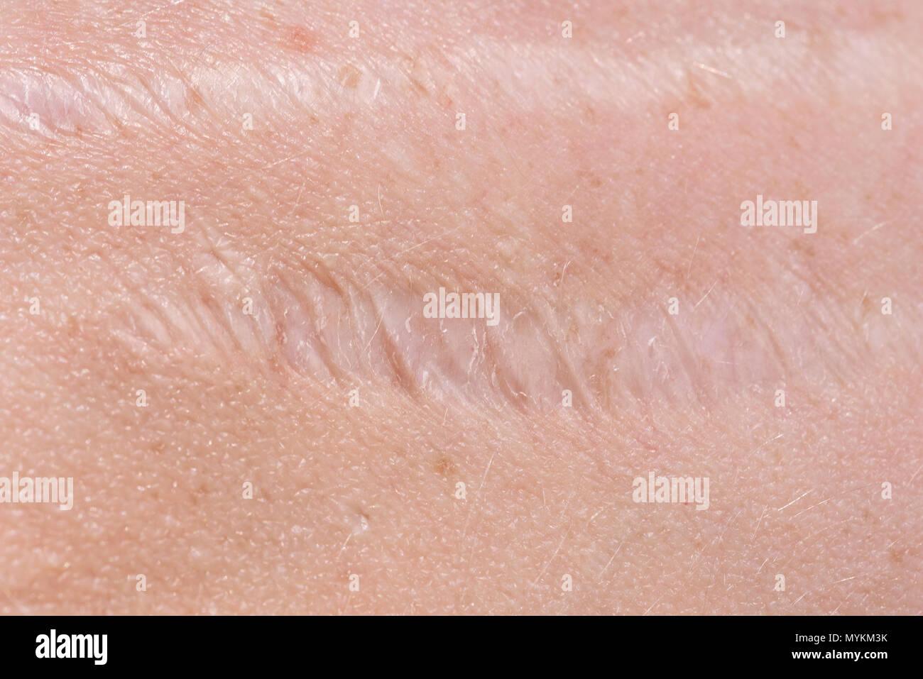 Cicatrice sulla pelle Foto Stock