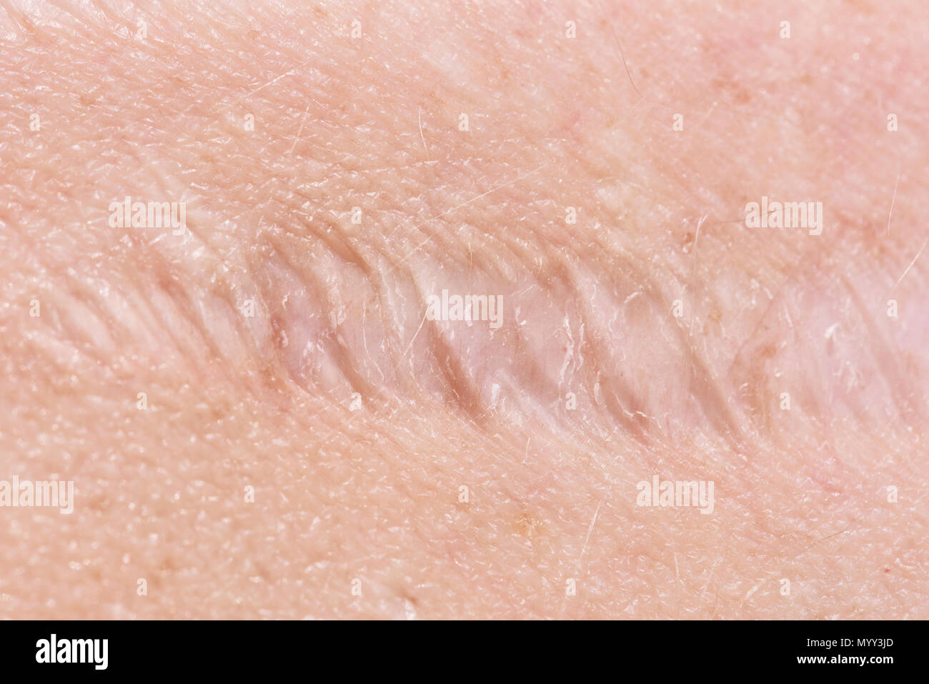 Cicatrice sulla pelle Foto Stock