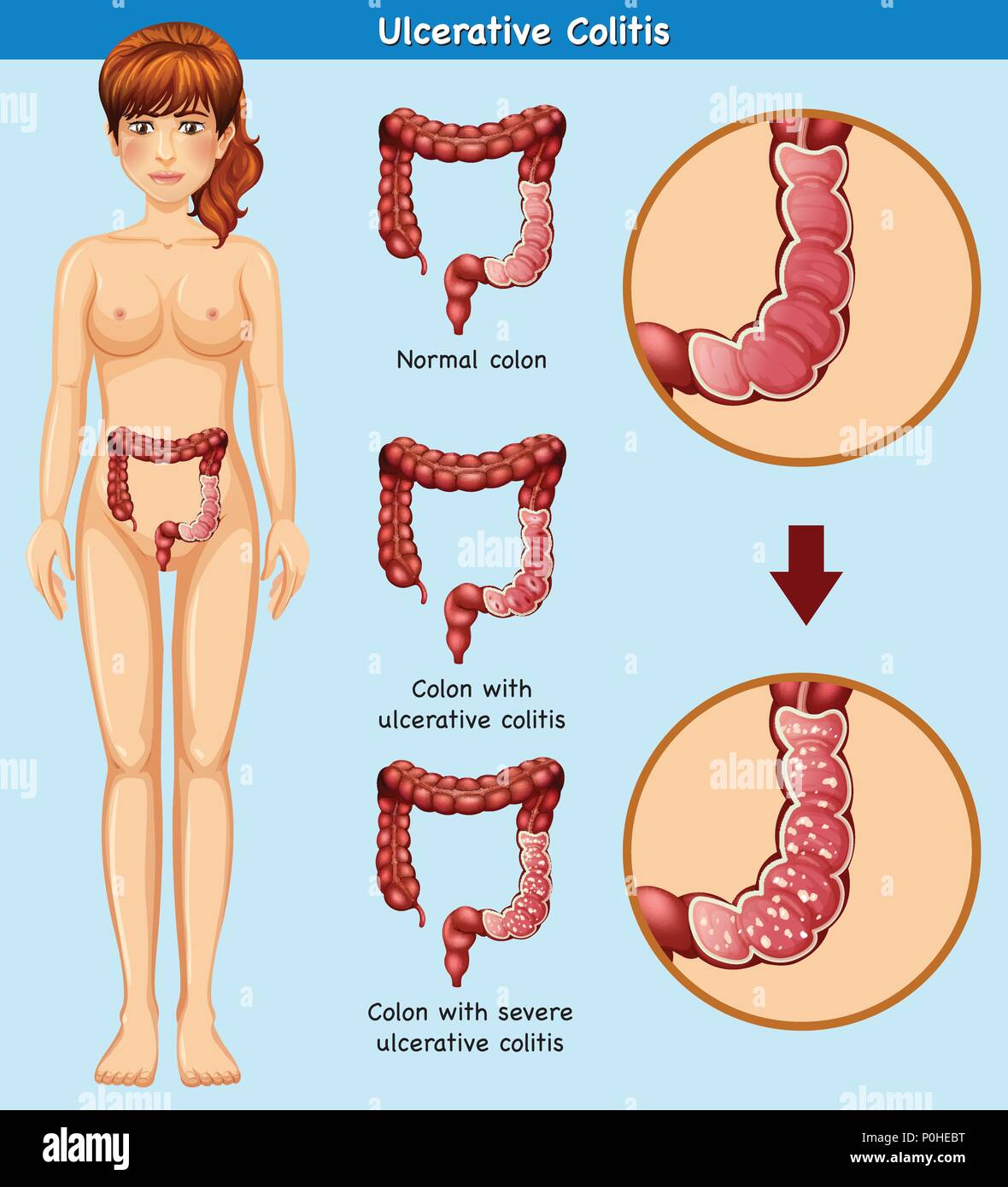 Anatomia umana della colite ulcerosa illustrazione Illustrazione Vettoriale