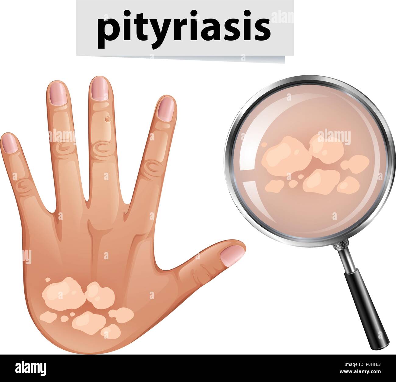 Un vettore della Pityriasis sulla pelle umana illustrazione Illustrazione Vettoriale