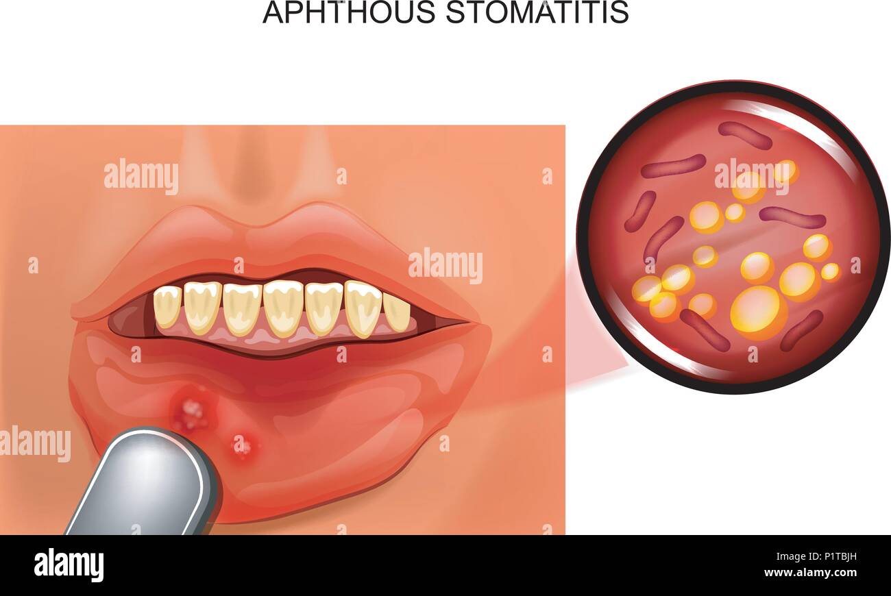 Illustrazione vettoriale di stomatiti aftose. aphthae nella mucosa orale Illustrazione Vettoriale