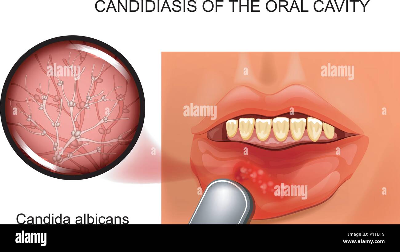 Illustrazione vettoriale di candidosi orale. agente causativo Candida albicans Illustrazione Vettoriale