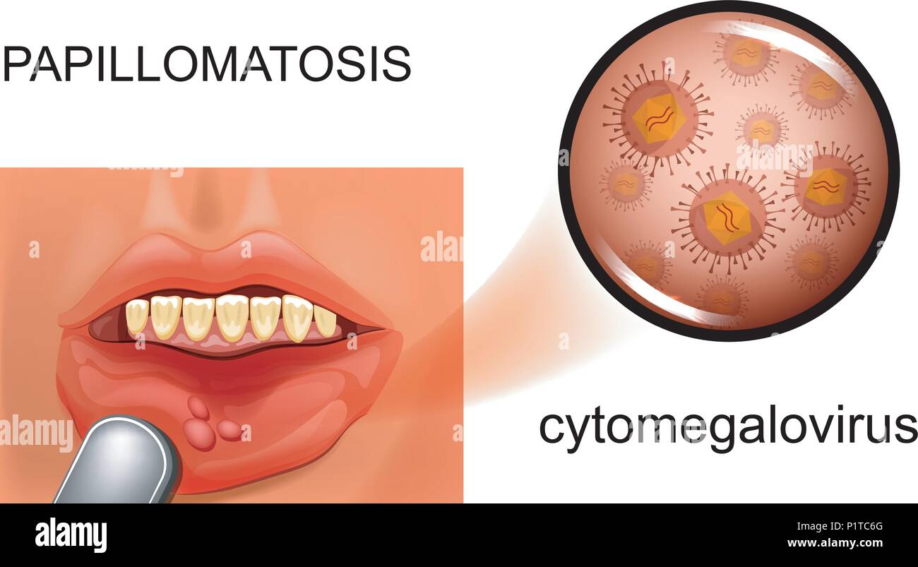 Illustrazione vettoriale di mucosa orale papillomatosi citomegalovirus. Illustrazione Vettoriale