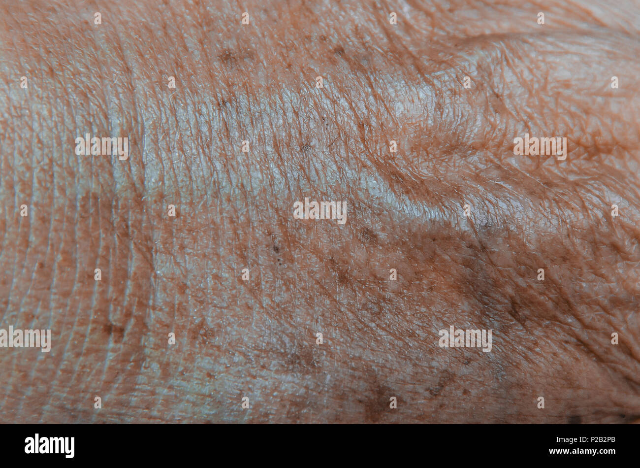 Close Up Di Macchie Marroni Sulla Pelle Pelle Macchie Sul Lato Causato Dalla Radiazione Proveniente Dal Sole Macro Della Ruga E Cicatrice Foto Stock Alamy