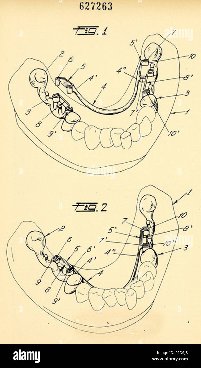 . Italiano: Gian Paolo Vanelli, brevetto di un dispositivo per dentature interrotte, Bologna 1961 . Italiano: Disegno per il brevetto per invenzione industriale n. 627263, classe A 61 C, di Gian Paolo Vanelli Onu per ciascun dispositivo di ancoraggio di protesi parziali per dentature interrotte, Bologna. Data di deposito: 4 marzo 1960. Data di concessione: 28 ottobre 1961 (come Genova, Ufficio provinciale industria, commercio e artigianato di Genova, Fondo Brevetti) . 28 ott. 1961 22 Gian Paolo Vanelli, brevetto di un dispositivo per dentature interrotte, Bologna 1961 - san dl SAN IMG-00002952 Foto Stock