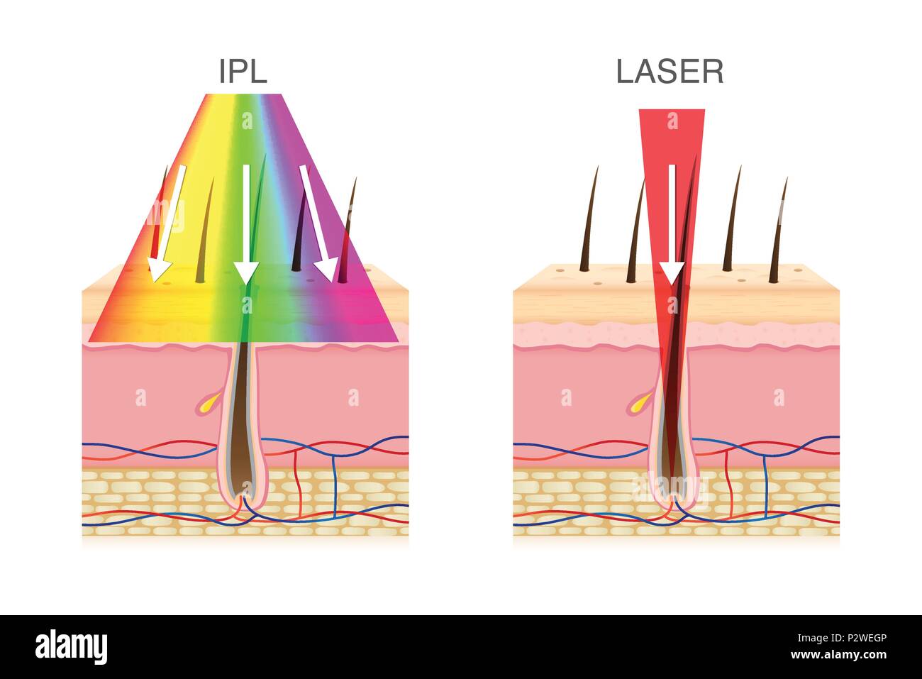 La differenza di utilizzando il sistema di epilazione a luce pulsata luce e laser nella rimozione dei peli. Illustrazione Vettoriale