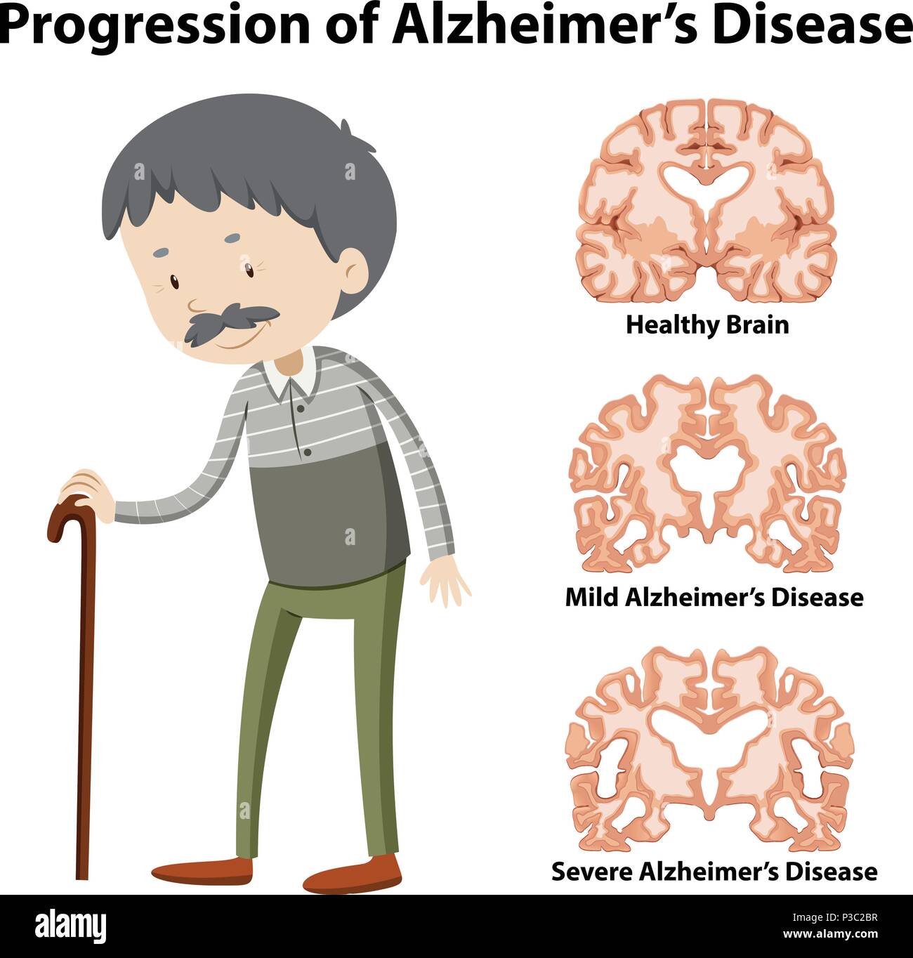 La progressione della malattia di Alzheimer illustrazione Illustrazione Vettoriale