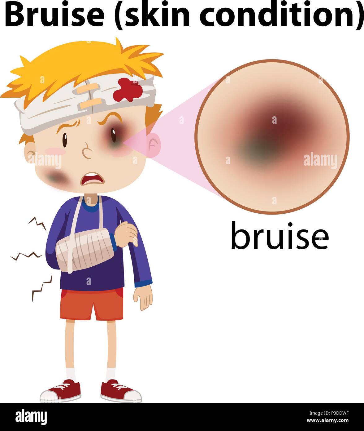 Un ragazzo avente livido sul viso illustrazione Illustrazione Vettoriale