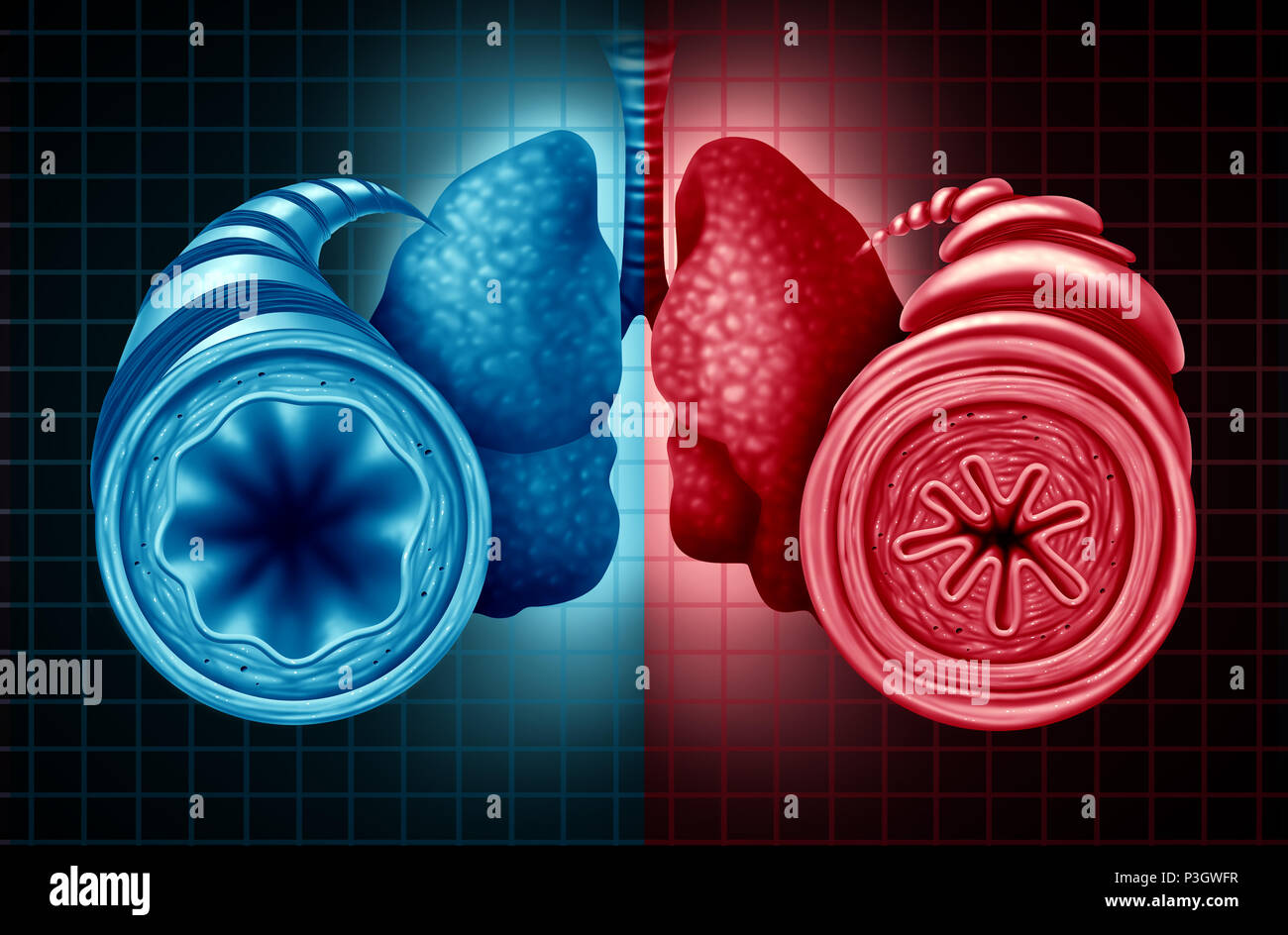 Asma diagnosi di salute come un diagramma con un sano e malsano tubo bronchiale con una respirazione ristretta problema causato da muscolo respiratorio. Foto Stock