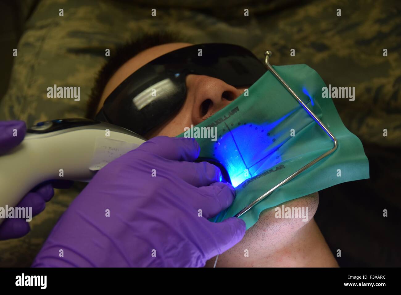 Il personale Sgt. Shane Hinton, 379 Expeditionary operazioni mediche Squadron odontotecnico, utilizza una luce di indurimento per solidificare liquidi materiali dentari all'interno di un canale radicolare su Senior Airman Giordania Thompson, 379 Expeditionary disponibilità logistica Squadron combustibili e triogenia operatore, luglio 30, 2016 at Al Udeid Air Base, in Qatar. Odontotecnici come Hinton eseguire pulizie dentali, preparare strumenti odontoiatrici, ed assistere i dentisti con procedure simili estrazioni e canali radicolari. (U.S. Air Force foto/Technical Sgt. Carlos J. Treviño/rilasciato) Foto Stock