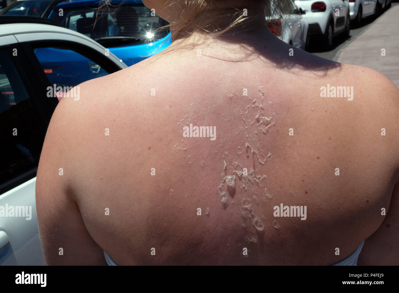 Giugno 2018 - Peeling sun bruciato la schiena di una giovane donna sulla vacanza isola di Tenerife. Foto Stock