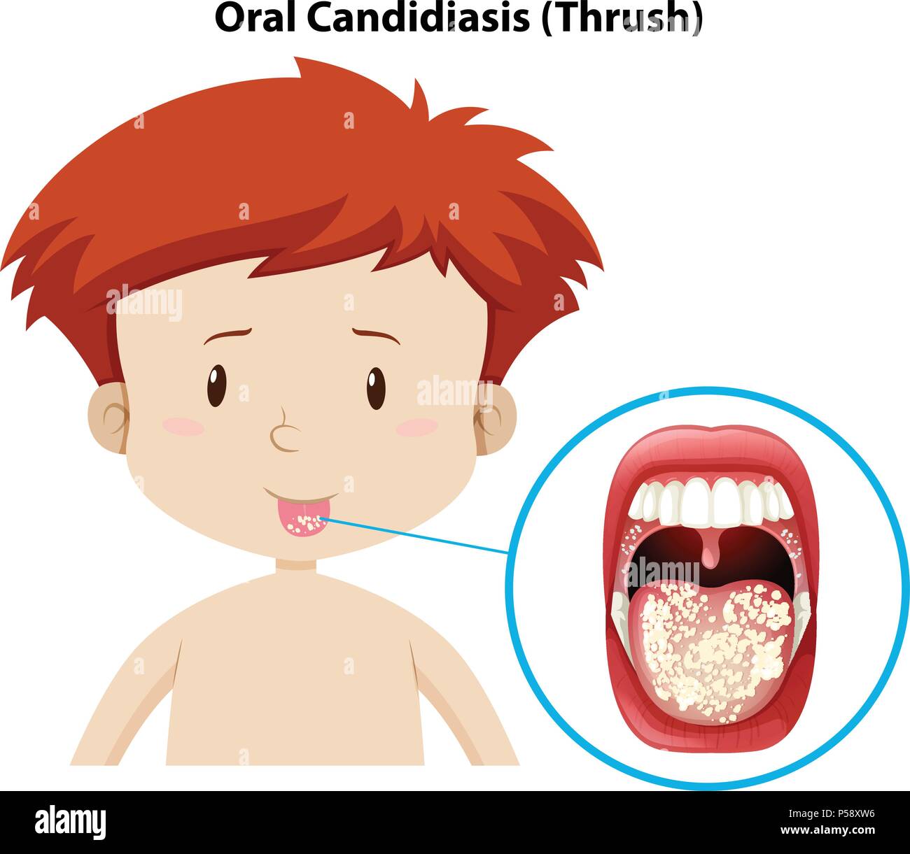 Un giovane ragazzo con candidosi orale illustrazione Illustrazione Vettoriale