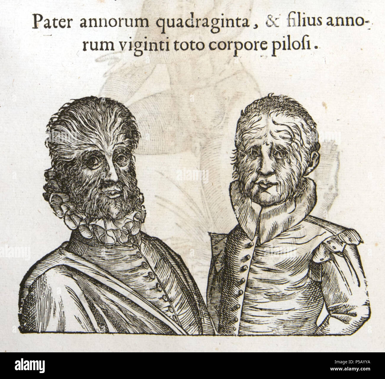 N/A. Français : Père de quanrante ans et Fils de vingt ans ayant tout le corps couvert de poils. Monstrorum historia d'Ulisse Aldrovandi, p. 16 . 1642. Jean-Baptiste Coriolan 78 Aldrovandi-0016 Foto Stock