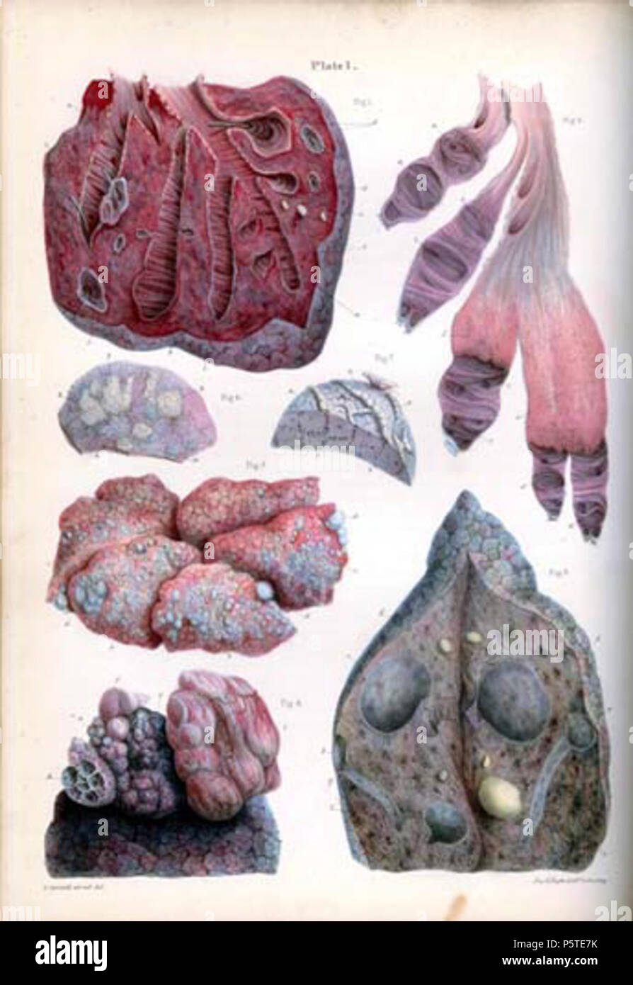 N/A. Inglese: anatomia patologica delle illustrazioni delle forme elementari di malattia . 8 gennaio 2014, 04:49:35. Robert Carswell 277 ipertrofia Carswell 1WF Foto Stock
