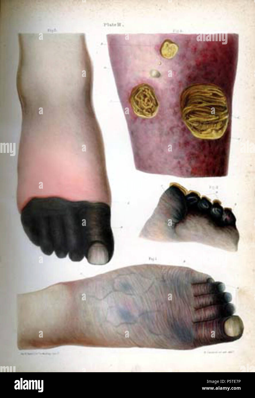 N/A. Inglese: anatomia patologica delle illustrazioni delle forme elementari di malattia . 8 gennaio 2014, 04:49:36. Robert Carswell 277 Carswell mortificazione 2WF Foto Stock