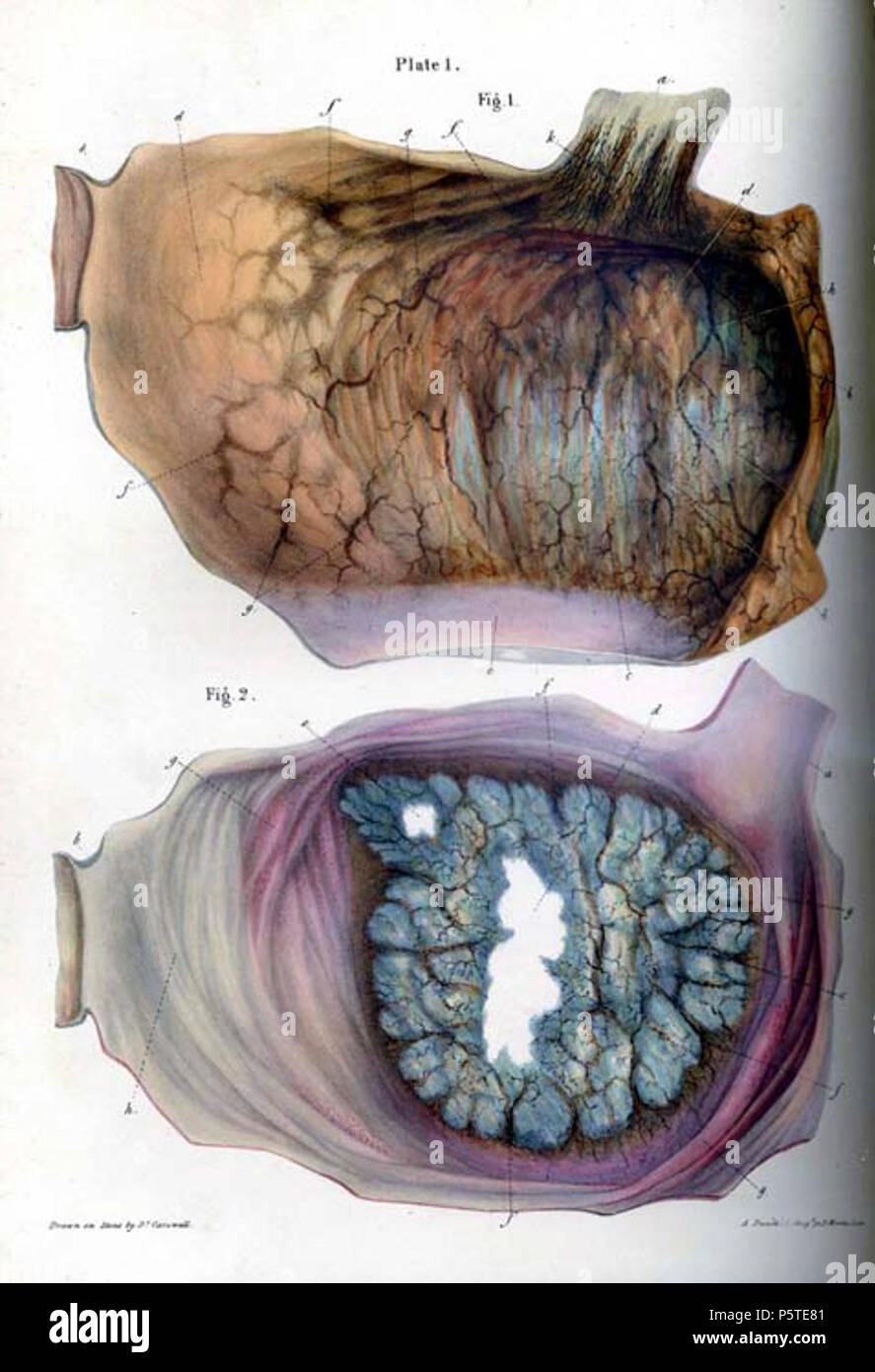 N/A. Inglese: anatomia patologica delle illustrazioni delle forme elementari di malattia . 8 gennaio 2014, 04:49:38. Robert Carswell 277 Carswell ammorbidimento 1WF Foto Stock